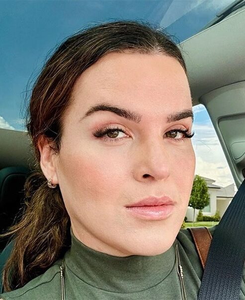 Case--5572 | After Facial Feminization Surgery