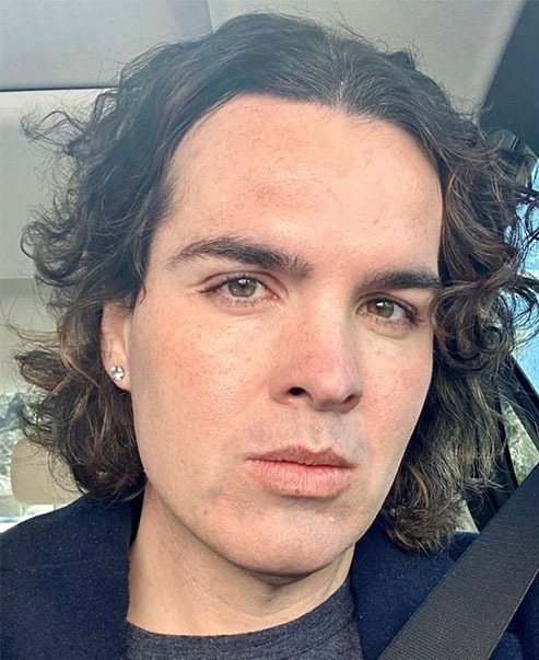 Case--5572 | Before Facial Feminization Surgery