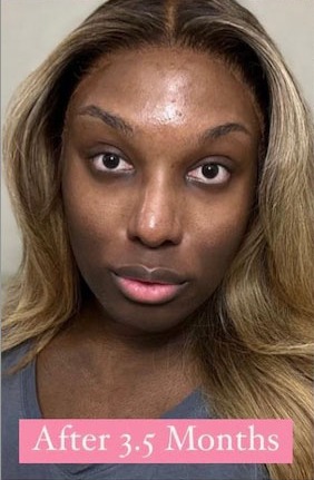 Case--5895 | After Facial Feminization Surgery