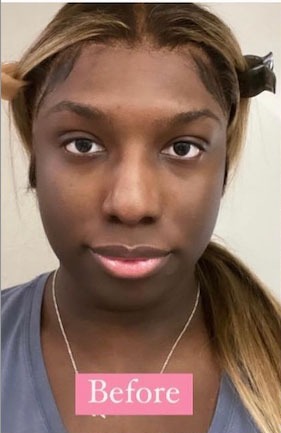 Case--5895 | Before Facial Feminization Surgery