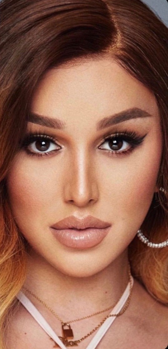 Case--3733 | After Facial Feminization Surgery