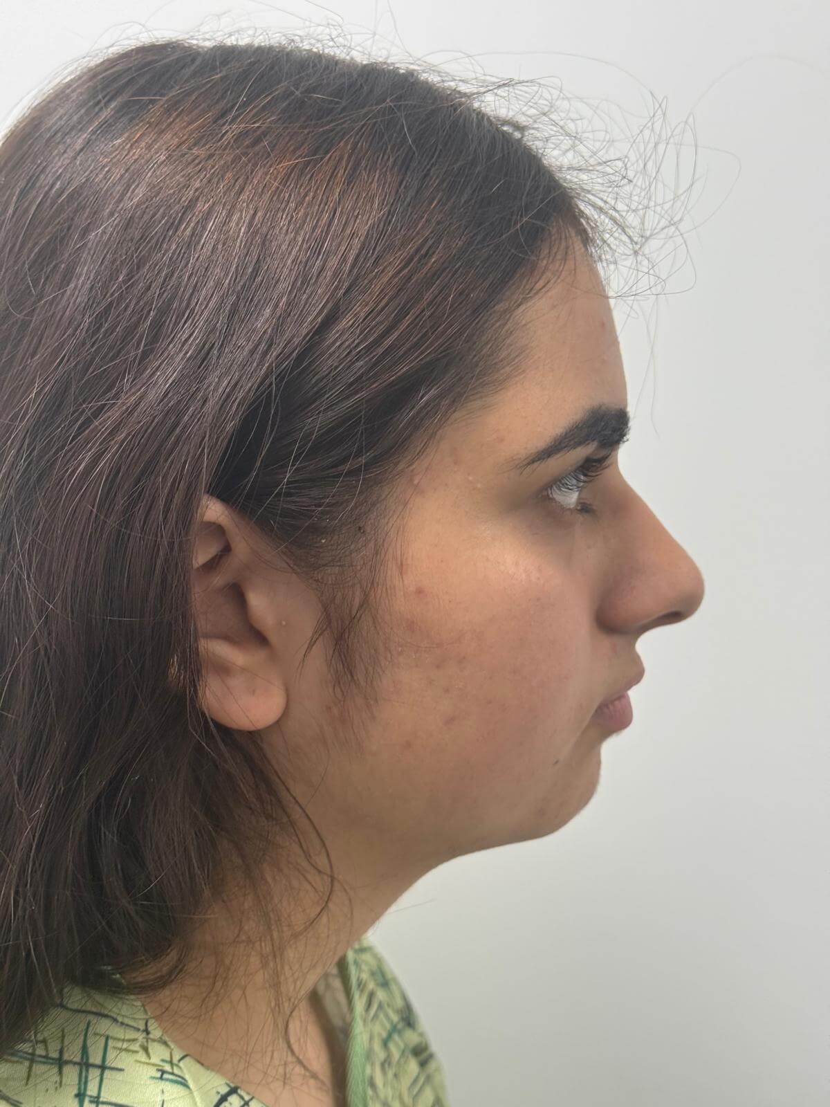 Case--6052 | Before Rhinoplasty